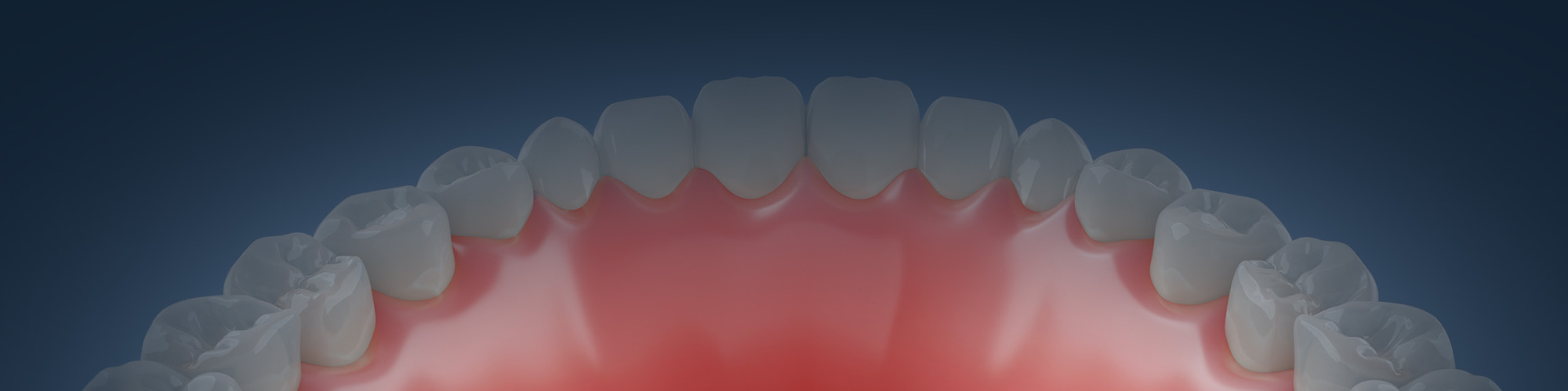 full arch dental implants in Northern Kentucky