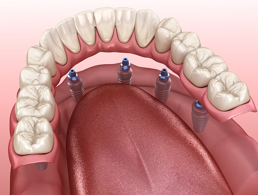 all on 4 dental implants in Northern Kentucky