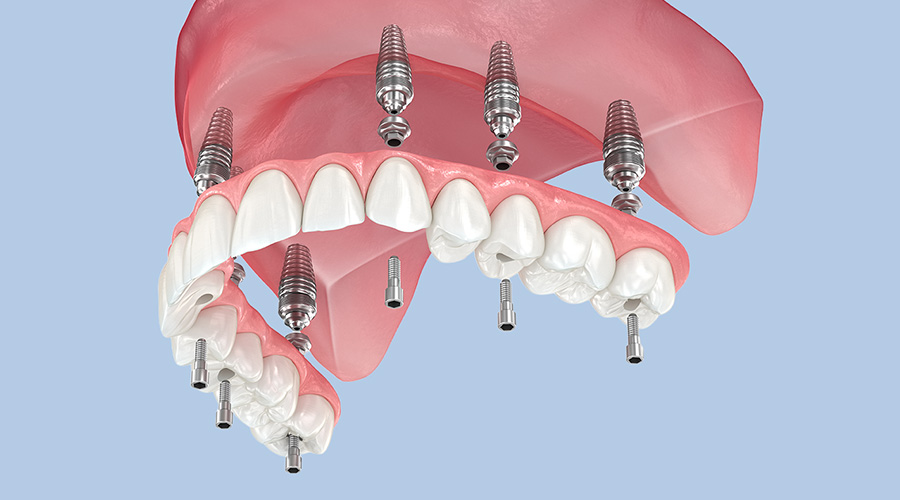 all on 6 full arch implants in Northern Kentucky